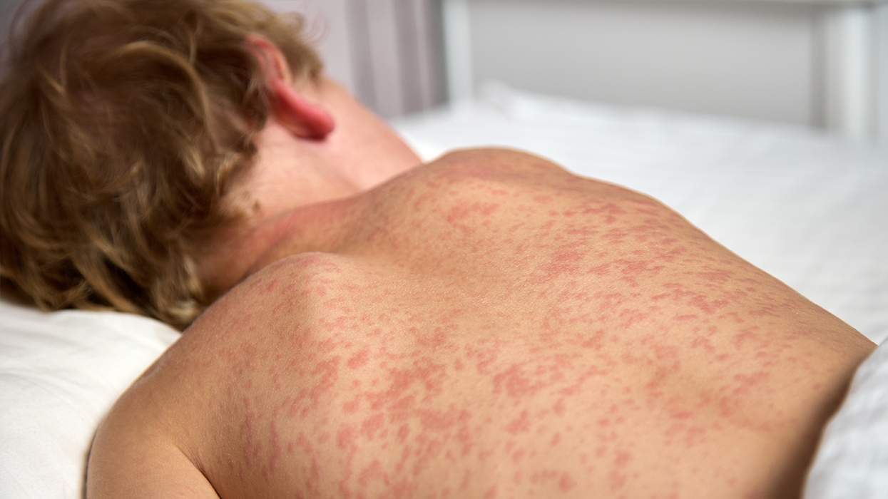 A child with rubella