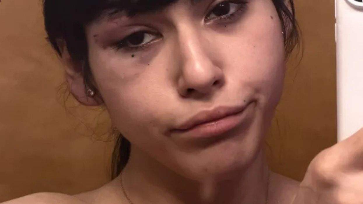 a person with injuries on her face