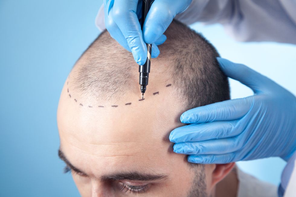 A surgeon drawing on the head of a hair loss patient