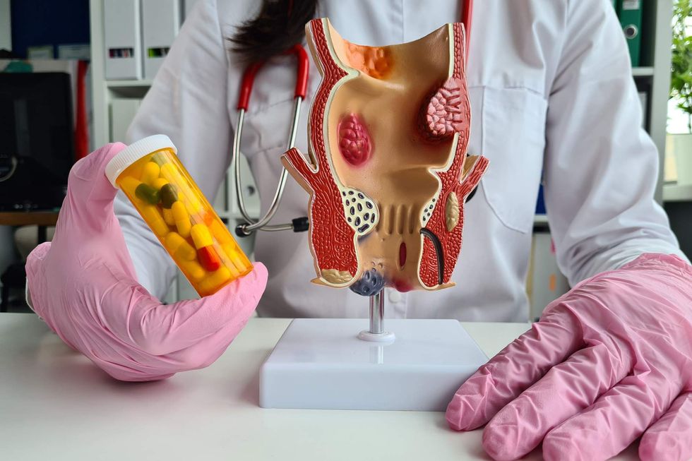 Doctor holds model of unhealthy lower rectum with inflamed vascular structures and medication pills.