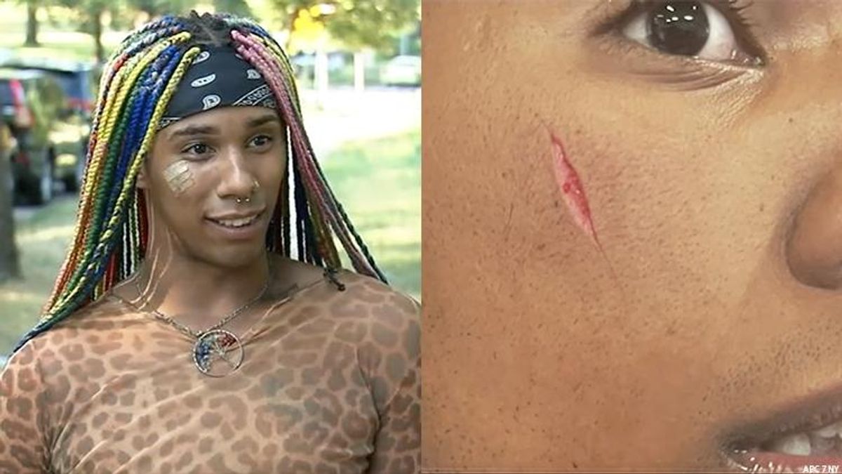 Harmony Vuitton, 22, says he was the victim of a homophobic attack