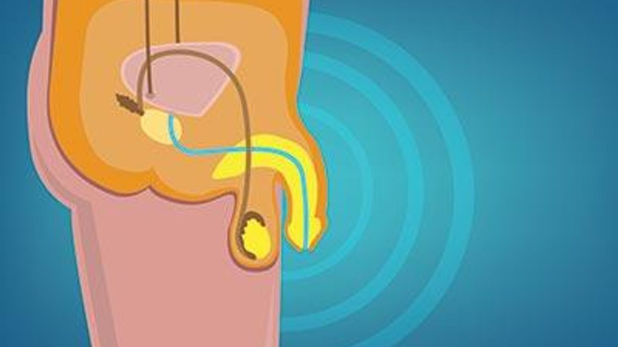 Could You be at Risk for Testicular Cancer?