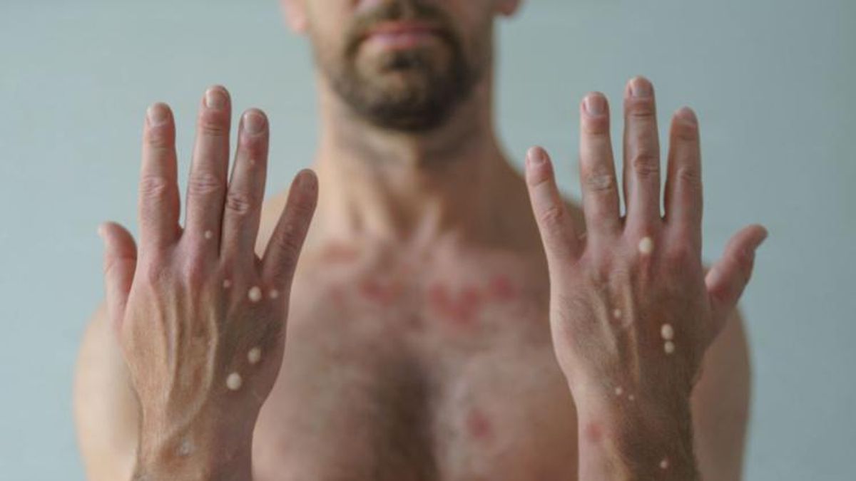 Man with monkeypox rash