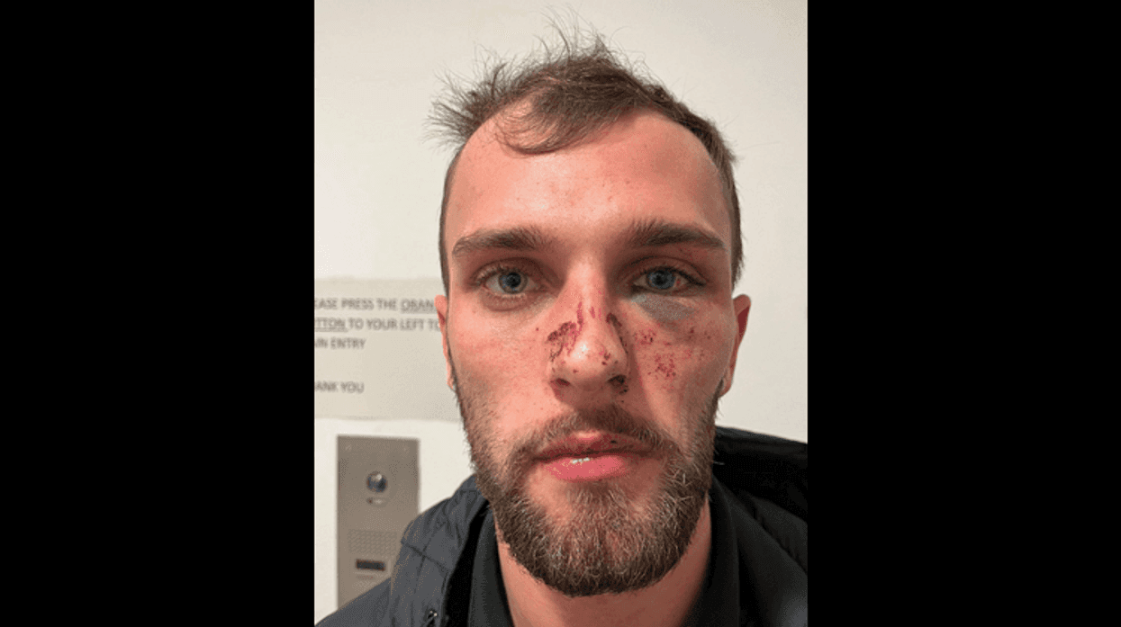 Ronan Gordan with a bruised face