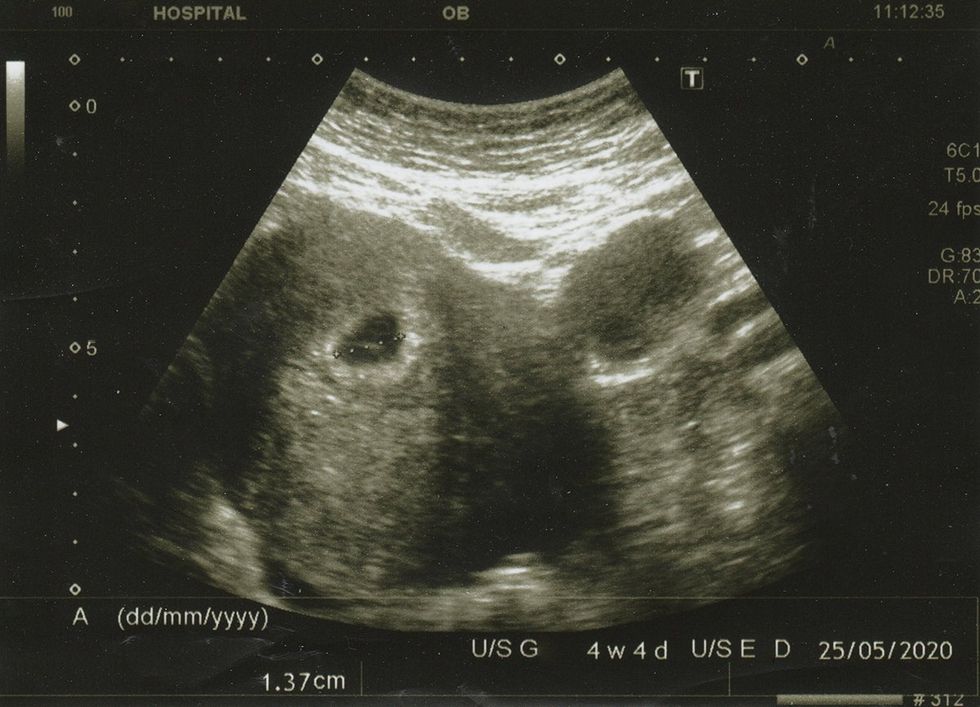 Six weeks pregnant fetus sonogram