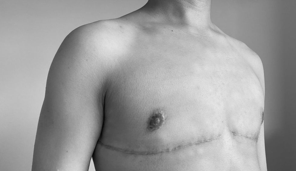 Transgender top surgery scars