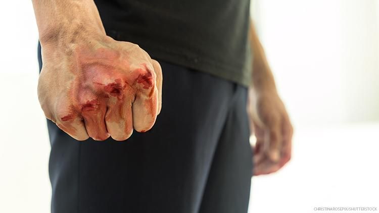 man with bloody knuckles